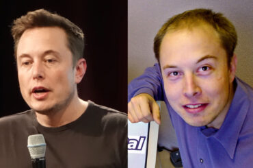 Story of Elon Musk's Hair Transplant - Things You Should Know. Bald Elon Musk Head before & after hair transplantation restoration