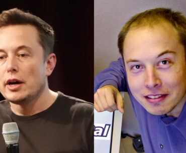 Story of Elon Musk's Hair Transplant - Things You Should Know. Bald Elon Musk Head before & after hair transplantation restoration