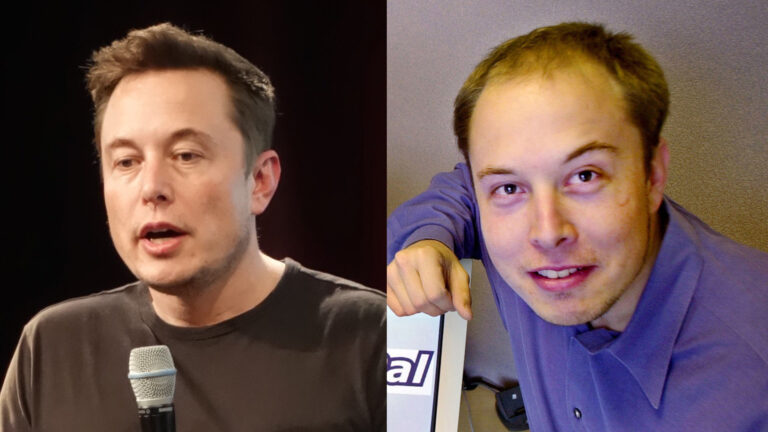 Story Of Elon Musk's Hair Transplant 